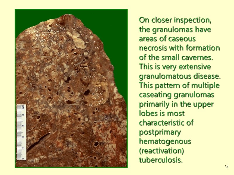 On closer inspection, the granulomas have areas of caseous necrosis with formation of the